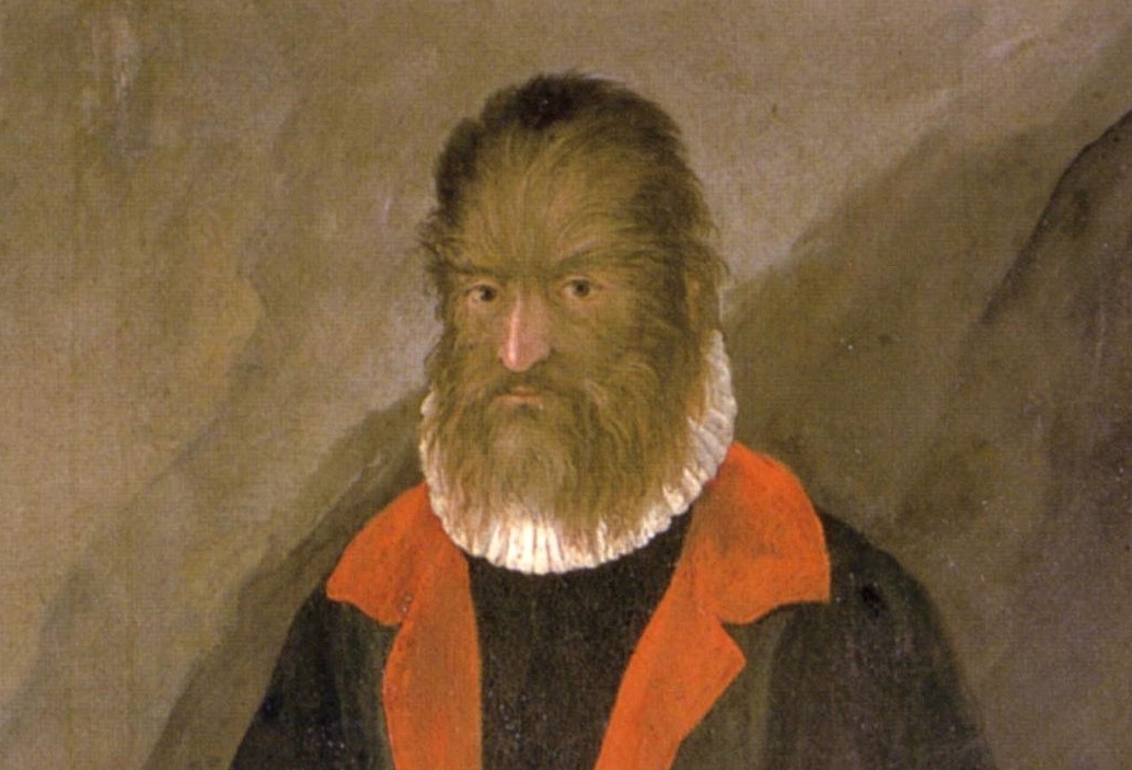 En este momento estás viendo HIPERTRICOSIS, QUÉ ES