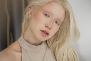 Lee más sobre el artículo QUÉ ES EL ALBINISMO