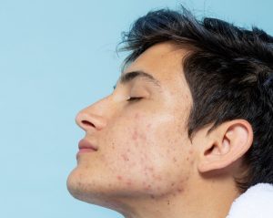 Lee más sobre el artículo SOBRE LA FOLICULITIS