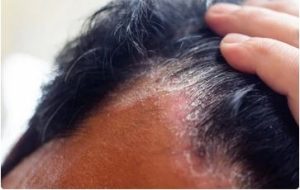 Lee más sobre el artículo QUÉ ES LA TIÑA