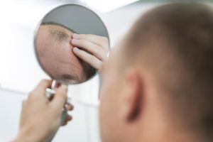 Lee más sobre el artículo QUÉ ES LA ALOPECIA Y TIPOS