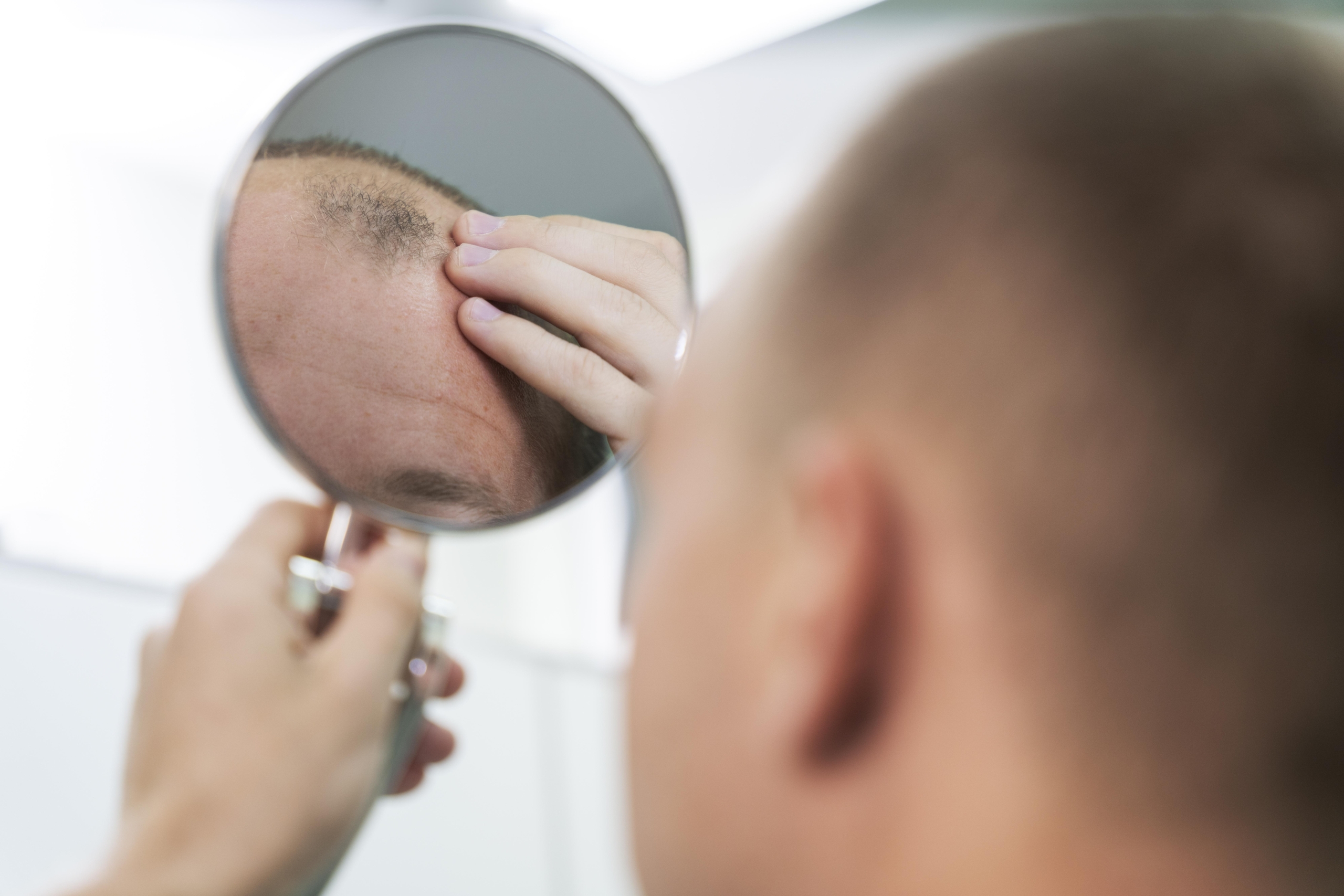 En este momento estás viendo QUÉ ES LA ALOPECIA Y TIPOS