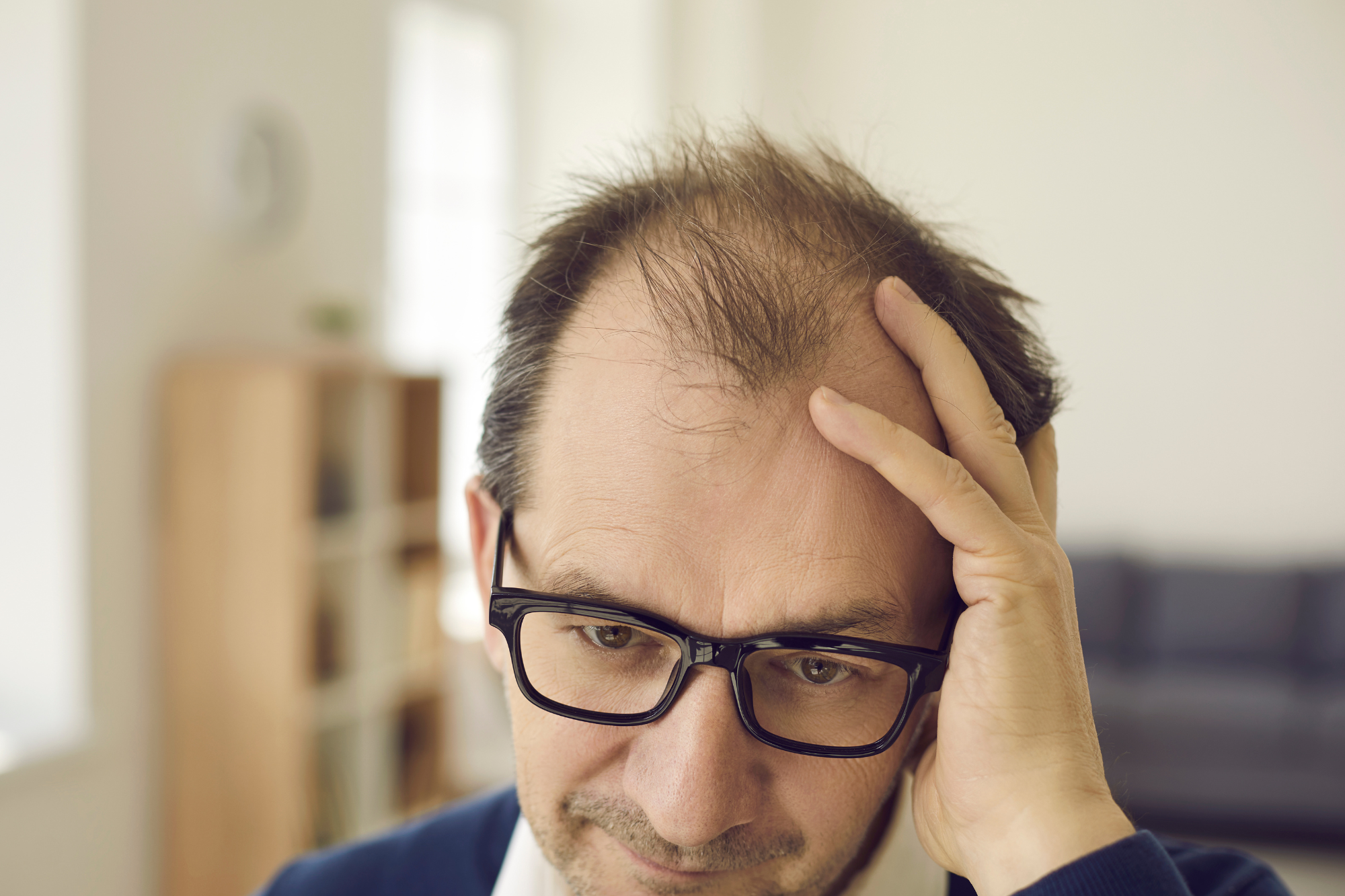 En este momento estás viendo IMPACTO PSICOLÓGICO DE LA ALOPECIA EN HOMBRES
