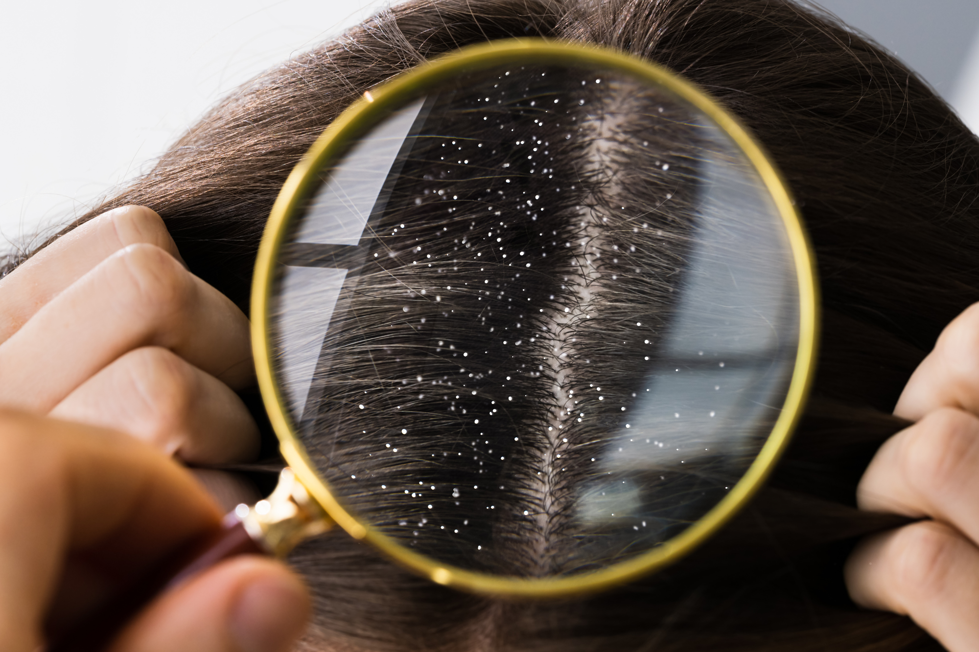 En este momento estás viendo ¿LA CASPA AFECTA POR IGUAL A HOMBRES Y MUJERES?