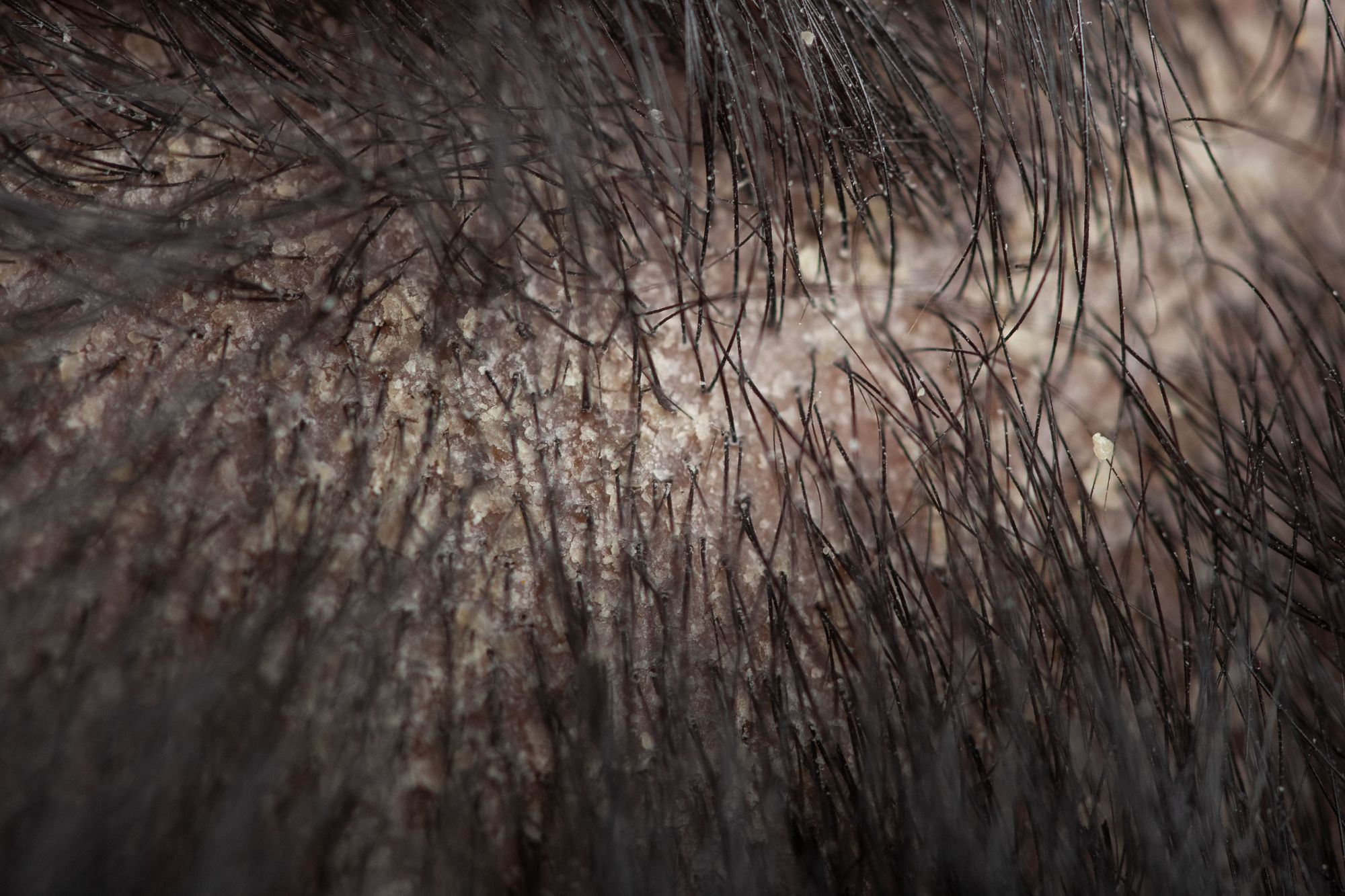 Sg Centro Capilares Dermatitis Seborreica--